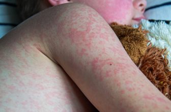 Two unvaccinated people die from measles in Pennsylvania, officials confirm